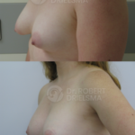 Tuberous Breast Correction