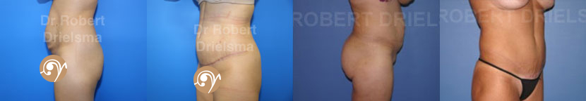 Tummy Tuck Sydney Before and After