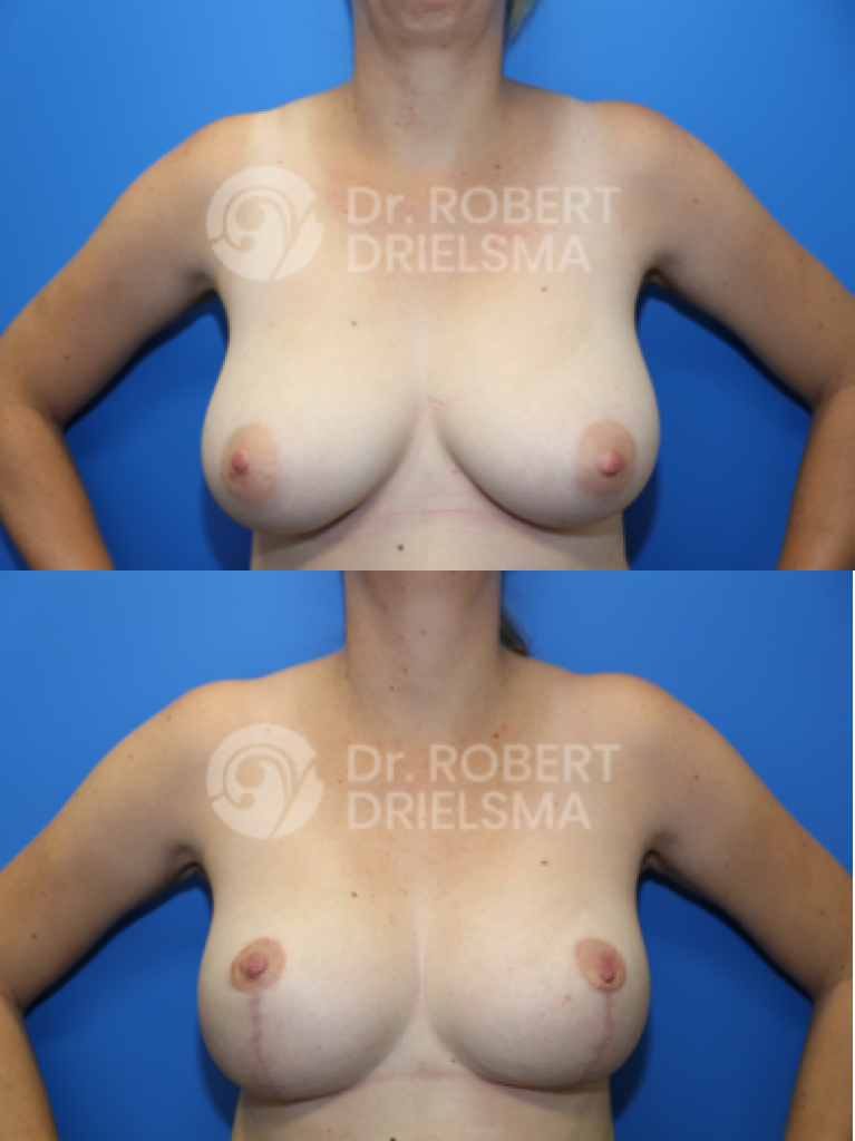 Breast Reduction Sydney Before and After