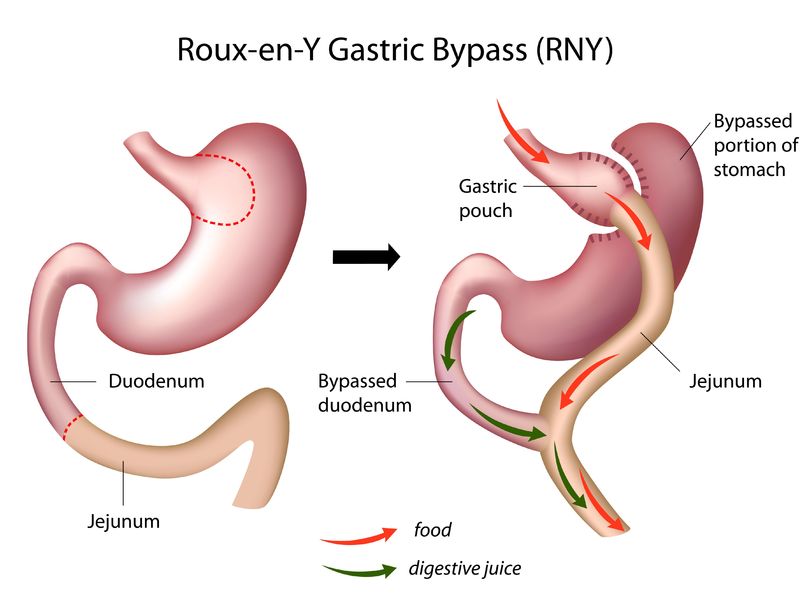 bariatric surgery