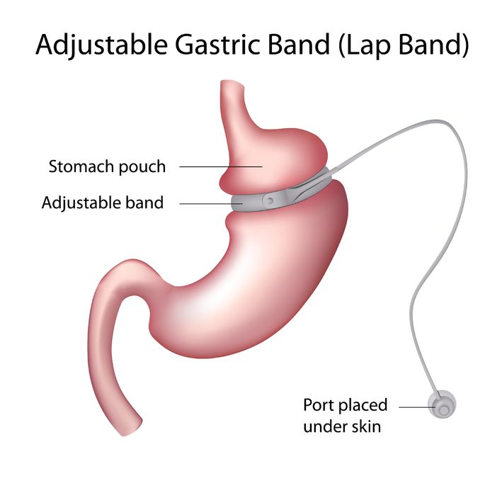 bariatric surgery
