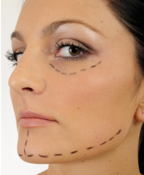 Pitfalls of Facelift Surgery – what you need to know