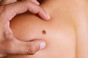 Mole Removal
