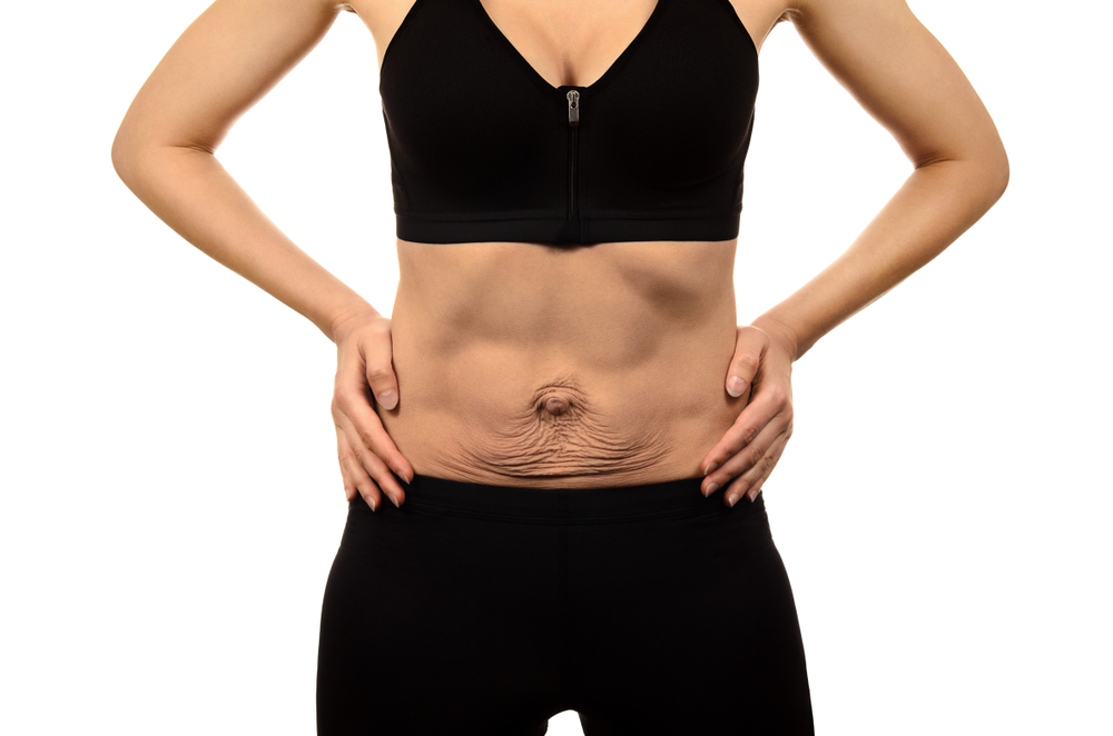 body lift after weight loss