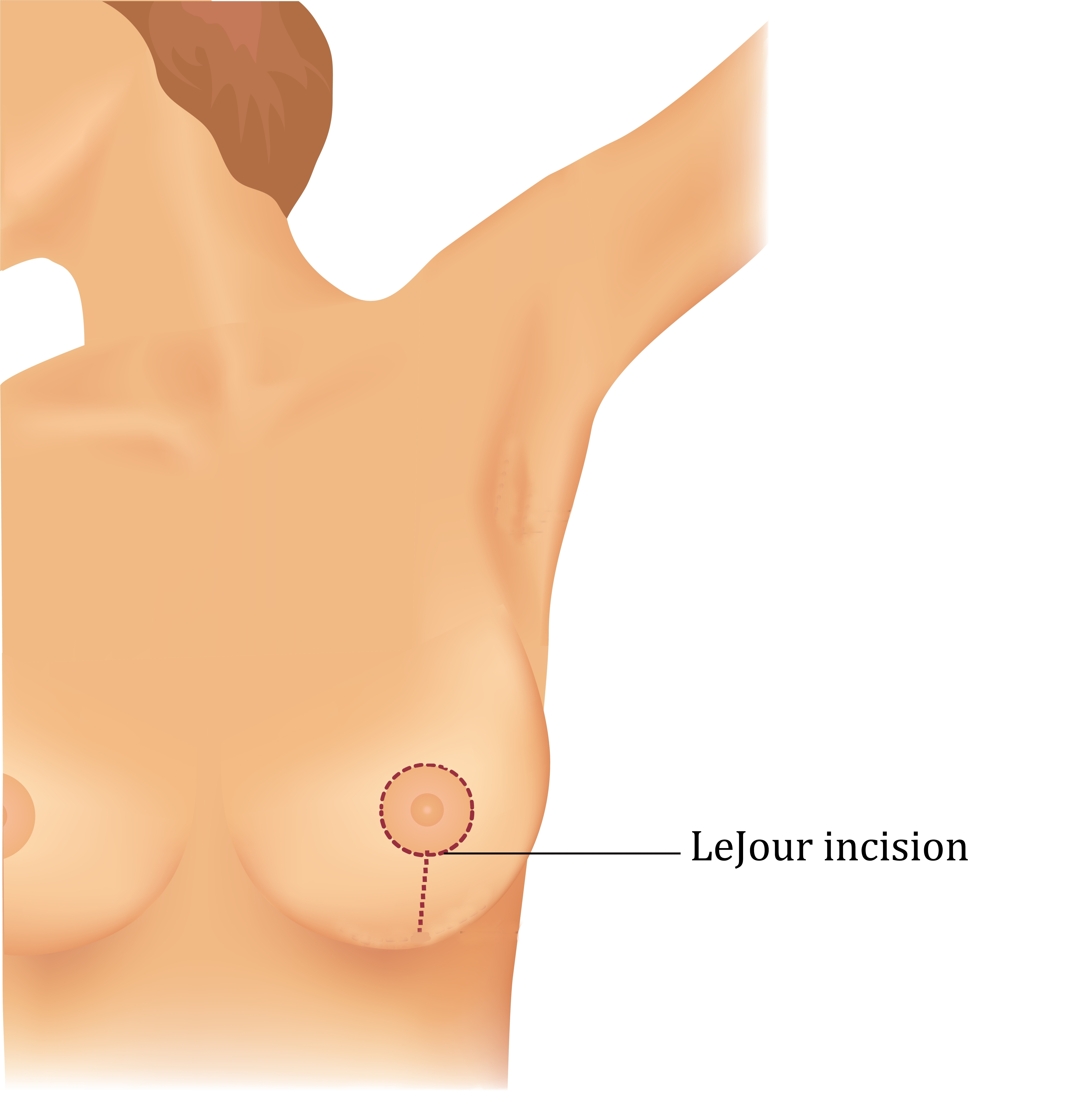 Top 3 Breast Lift Techniques and Why the Lollipop (Vertical Mammoplasty) Breast Lift is so Popular!