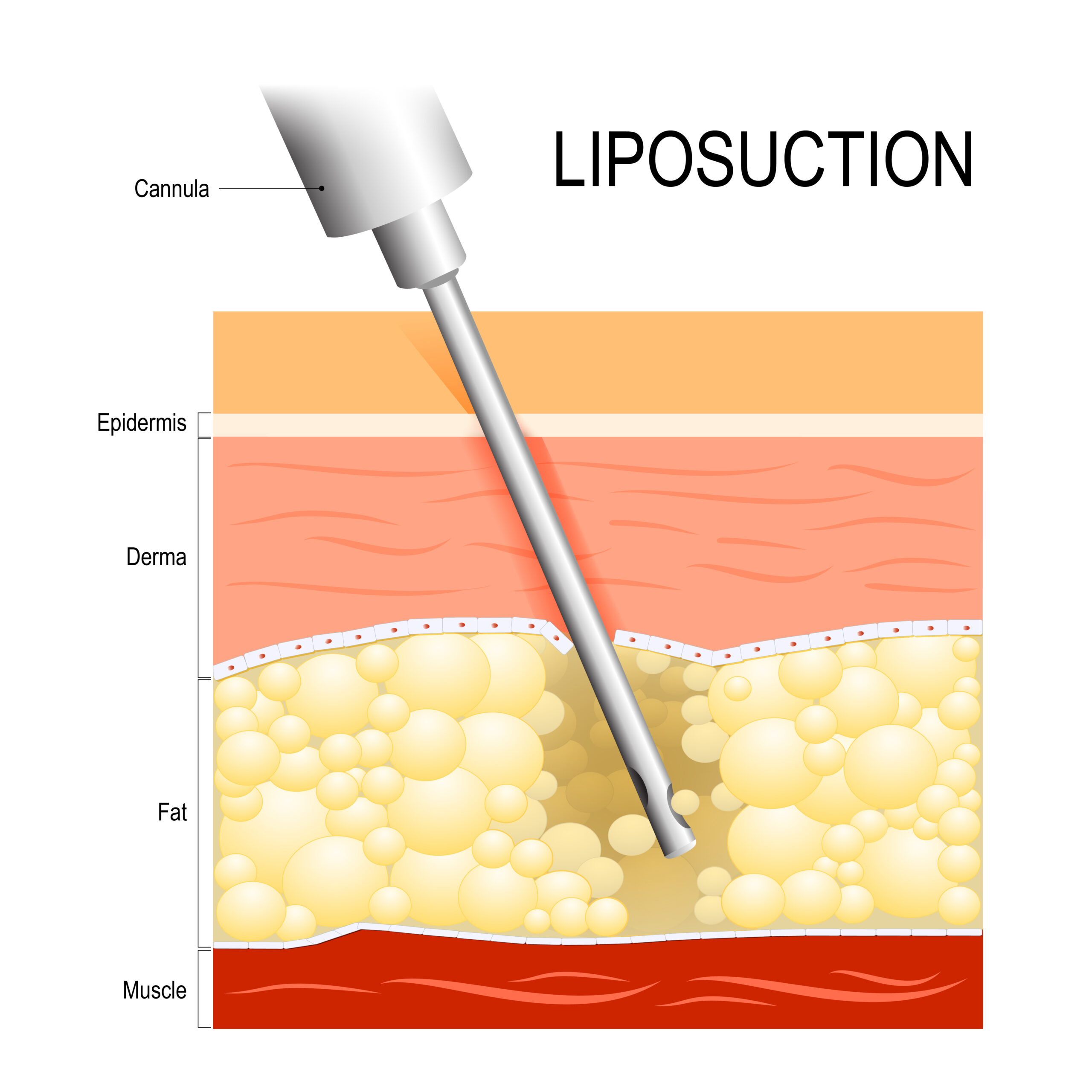 liposuction breast reduction