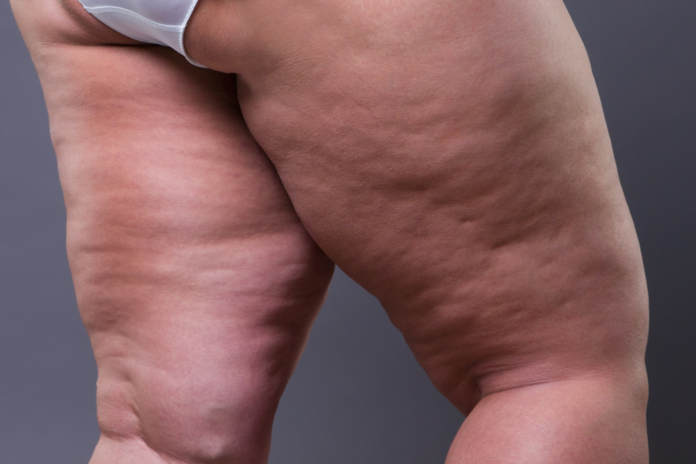 tummy tuck after weight loss