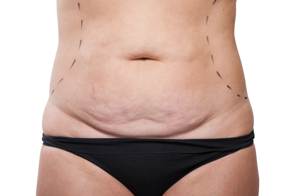 tummy tuck after weight loss