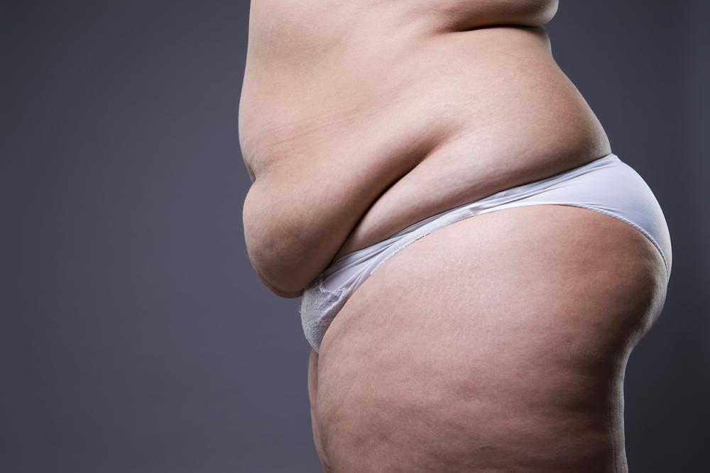 tummy tuck after weight loss