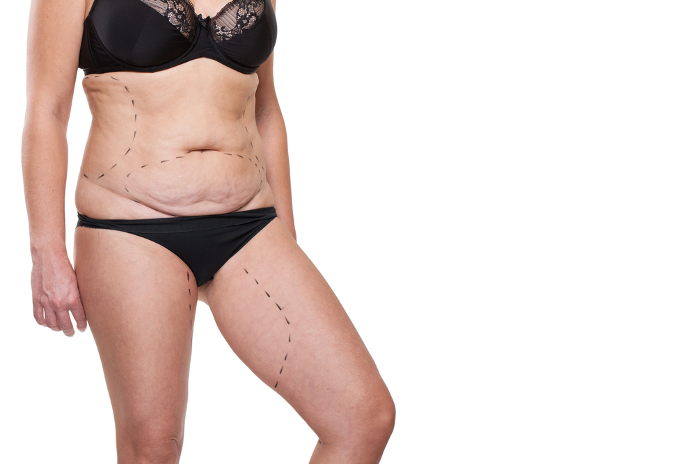 Top 9 Reasons For an Abdominoplasty After Weight Loss or Pregnancy!